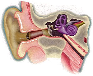 Inside of the Human Ear, showing a Canal Hearing Aid, inside the canal of the ear.